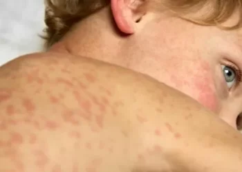 Estados Unidos: el sarampión resurge con cifras alarmantes por la desvaloración cobertura de vacunación