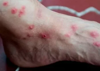 Confirman dos nuevos casos de viruela del mono en Córdoba: ya son seis los diagnósticos en la departamento