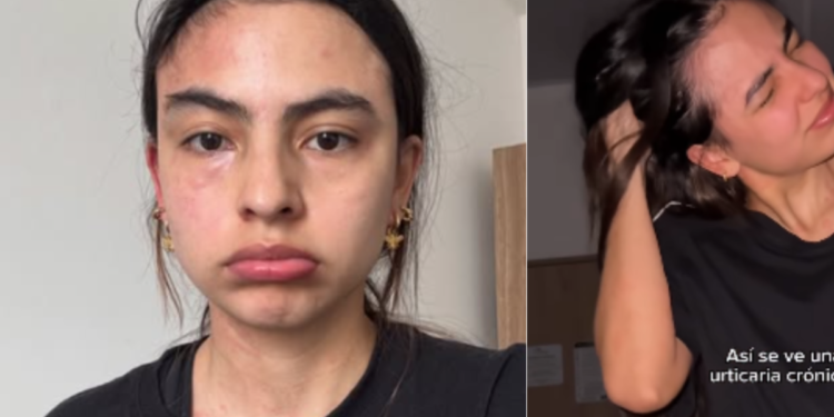 Michell Orozco, actriz de ‘Lady, la vendedora de rosas’, lleva tres meses sin poder dormir por una crisis de erupción crónica: ‘Ha sido monstruoso’